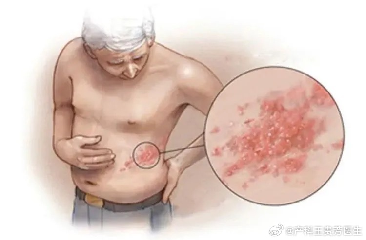 拆快递后揉眼引发眼部带状疱疹，案例分析与观点论述
