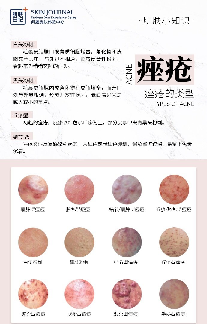 最新痤疮论述，现代观点、争议与探讨